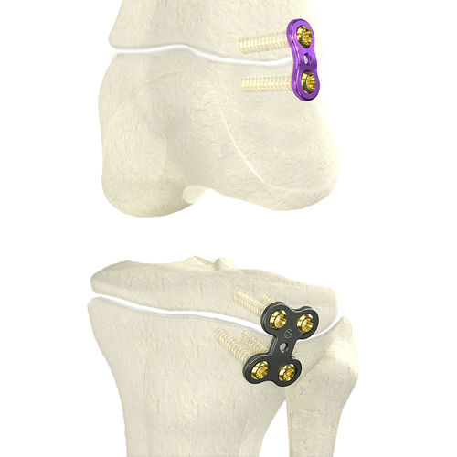 Osteotomieplatte für Oberschenkelknochen - WishFIX™ - WishBone Medical - für Tibia / proximal / distal
