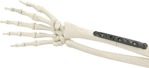 Kompressionsplatte für Radius - PK-SCP2704-TI - WishBone Medical - medial / Metall / für Kinder