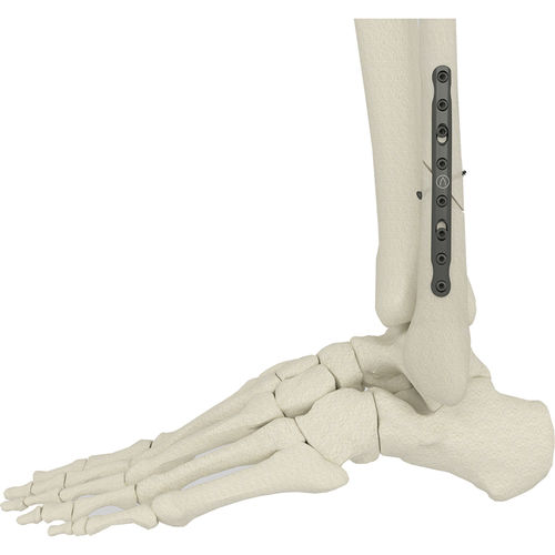 Osteotomieplatte für Fibula - PK-SFP series - WishBone Medical - medial / ohne Verriegelung / Metall