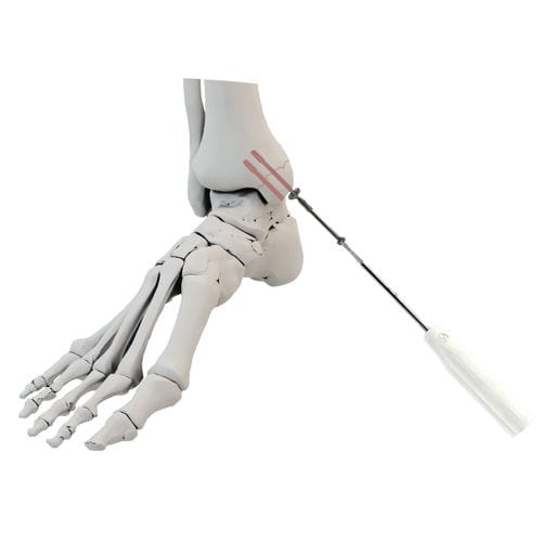 Arthrodeseschraube für Malleolus - WishBone Medical - kanüliert / Titan / kortikal