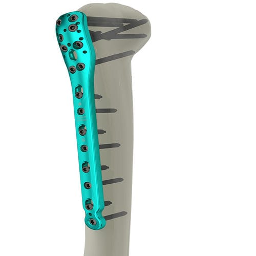 Kompressionsplatte für Humerus - 10-2200 series - WishBone Medical - proximal / mit Verriegelung