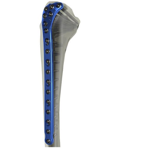 Kompressionsplatte für Tibia - WishBone Medical - proximal / mit Verriegelung / Titan