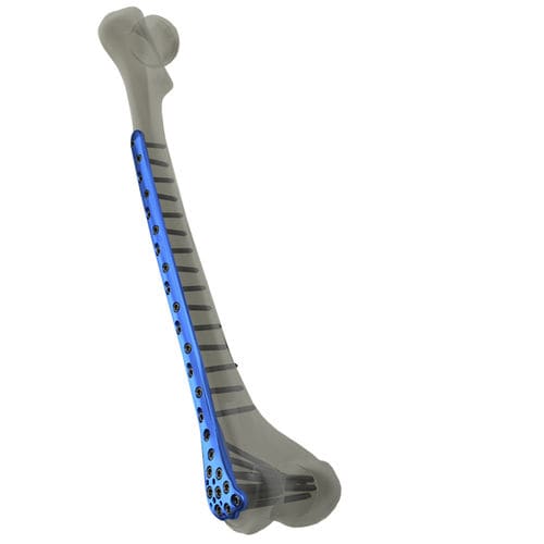 Kompressionsplatte für Oberschenkelknochen - WishBone Medical - distal / mit Verriegelung / Titan