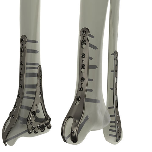 Kompressionsplatte für Tibia - STEP®  - WishBone Medical - für Fibula / für Malleolus / distal