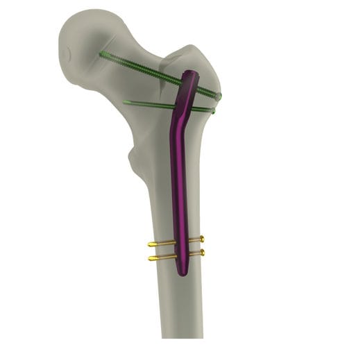 Marknagel für Oberschenkelknochen - PediFIN® - WishBone Medical - mit proximaler Fixierung / für Kinder