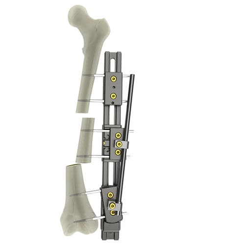Fixateur externe / für Oberschenkelknochen - UniX®  - WishBone Medical - rohrförmig / für Erwachsene
