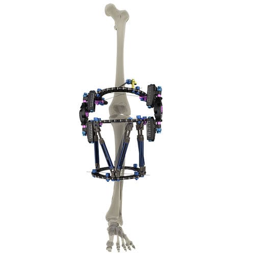 Fixateur externe / Knie - WishBone Medical - ringförmig / für Erwachsene