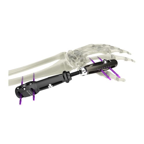 Fixateur externe / für Handgelenk - UniX® - WishBone Medical - für Radius / rohrförmig / für Erwachsene