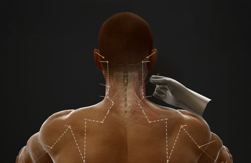 Visualisierungssoftware - AcuMap - Medical Augmented Intelligence (MAI) - Umform / Ausbildung / Kartografie