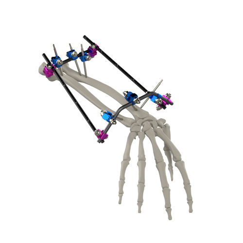 Fixateur externe / für Ellbogen - TF-TUBU Small Fix - TASARIMMED - für Handgelenk / für Humerus / für Radius