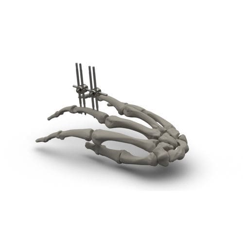 Modularer Fixateur externe - TASARIMMED - für Fingergrundgelenk / rohrförmig / für Erwachsene