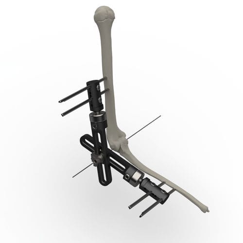 Fixateur externe / für Ellbogen - TF-8000-1 - TASARIMMED - rohrförmig / für Erwachsene