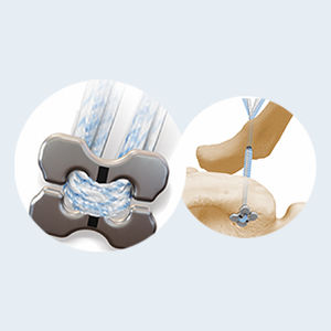 Button zur Rekonstitution des Akromio-Klavicular-Bandes - EB3F - Star Sports Medicine