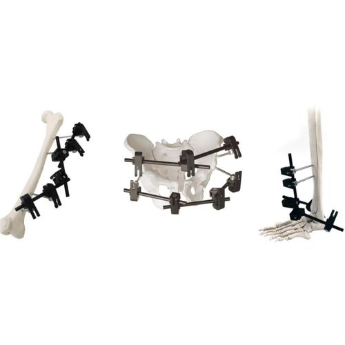 Modularer Fixateur externe - QuickX  - Zhejiang Borumon Biological Technology - rohrförmig / für Erwachsene