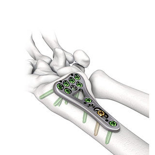 Kompressionsplatte für Radius - Changzhou Dingjian Medical Equipment - distal / mit Verriegelung / Metall