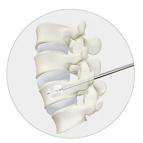 Vertebroplastie-System / Ballonkatheter - Princeton Medical Scientific - für perkutane Kyphoplastie