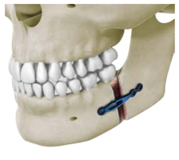 Osteotomieplatte für Unterkiefer - Delphos Implants - Metall