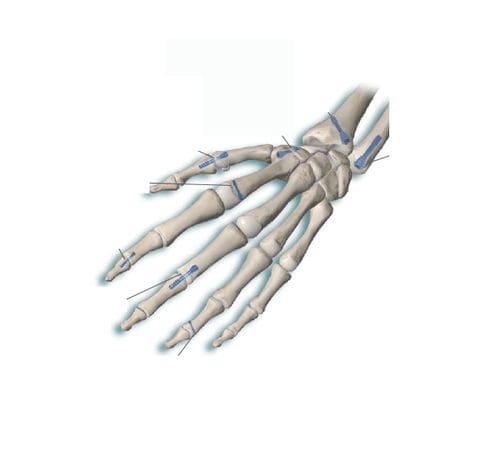 Knochen-Kompressionsschraube / für Mittelhandknochen - Delphos Implants - für Fingerglied / ohne Kopf / Metall