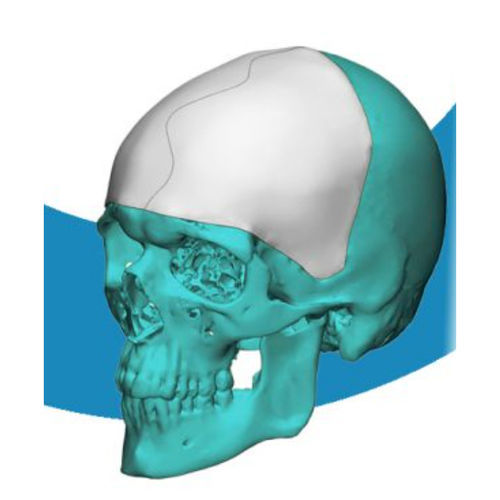 Patientenspezifisches Schädelimplantat - 4350 - Poriferous