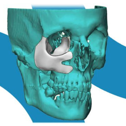 Patientenspezifisches Orbitalimplantat - 4353 - Poriferous