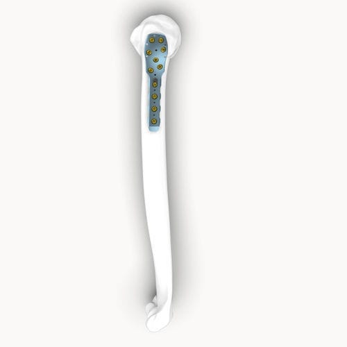 Kompressionsplatte für Humerus - Eonex Medical - proximal / mit Verriegelung / ohne Verriegelung