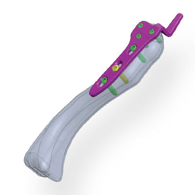 Osteotomieplatte für Acromioclaviculargelenk - Invamed - proximal / mit Verriegelung / Metall
