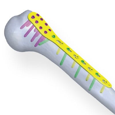 Kompressionsplatte für Humerus - Invamed - proximal / mit Verriegelung / Metall