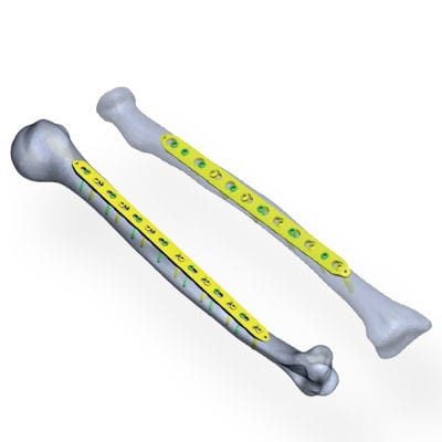 Kompressionsplatte für Radius - Invamed - für Ulna / für Humerus / medial