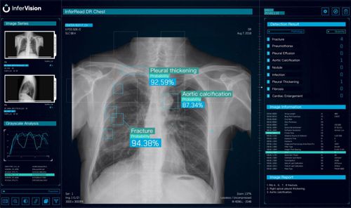 Analysesoftware - DR Chest - Beijing Infervision Technology Co. Ltd. - Visualisierung / Reporting / medizinisch