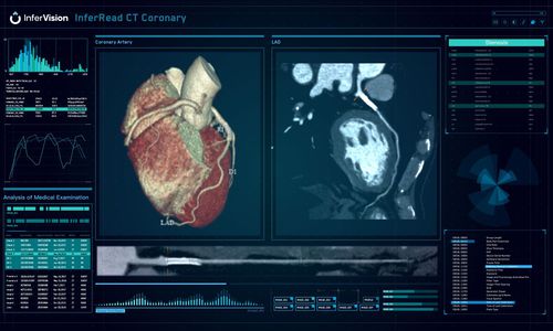Medizinische Software - InferRead® - Beijing Infervision Technology Co. Ltd. - Computertomographie / Analyse / Datenverwaltung
