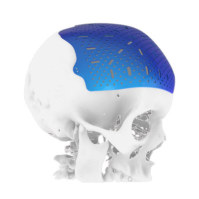 Patientenspezifisches Schädelimplantat - Osteophoenix