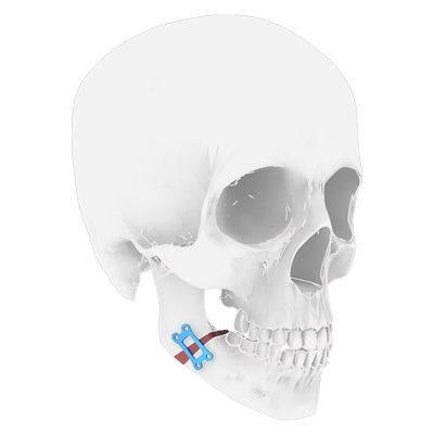 Osteotomieplatte für Unterkiefer - Osteophoenix - Titan