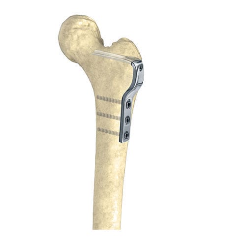Osteotomieplatte für Oberschenkelknochen - Wuxi Betta Medical Technology - proximal / mit Verriegelung / Metall