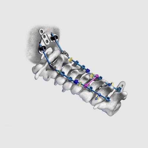 Okzipito-zervikales Stabilisierungssystem für Osteosynthese - Wuxi Betta Medical Technology - dorsaler Zugang / für Erwachsene