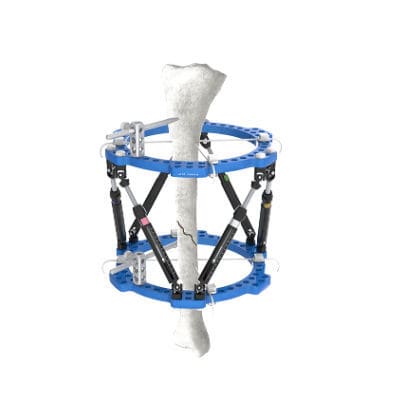 Fixateur externe / für Tibia - Wuxi Betta Medical Technology - für Knöchel / ringförmig / für Erwachsene