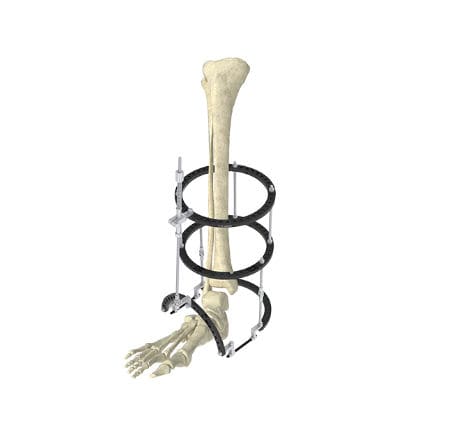 Fixateur externe / für Knöchel - Wuxi Betta Medical Technology - ringförmig / für Erwachsene