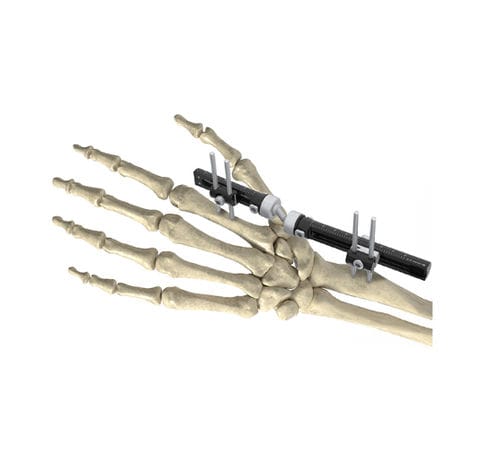 Fixateur externe / für Handgelenk - Wuxi Betta Medical Technology - für Humerus / für Radius / für Ulna