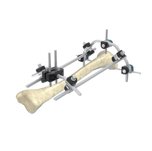 Fixateur externe / für Tibia - Wuxi Betta Medical Technology - hybrid / für Erwachsene