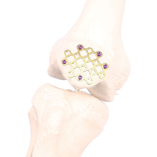 Kompressionsplatte für Patella - WX 2.7  - Kangli Medical - mit Verriegelung / Titan