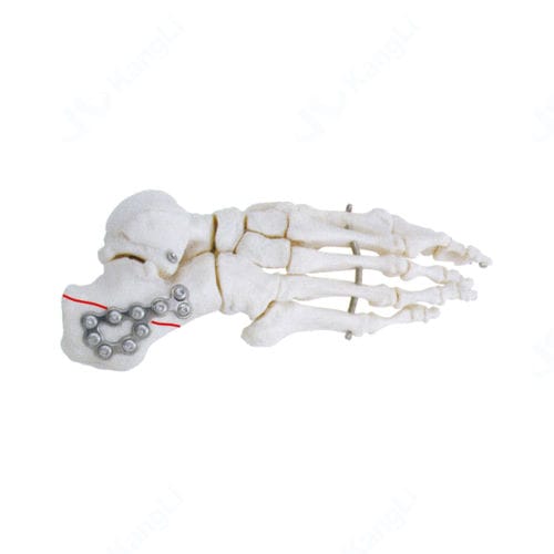 Kompressionsplatte für Calcaneum - T3010 - Kangli Medical - ohne Verriegelung / Titan