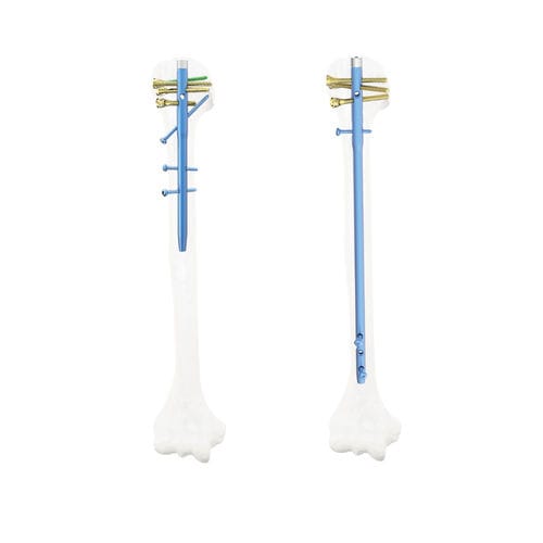 Marknagel / Humerus - QML - Kangli Medical - rechts / links / Titan