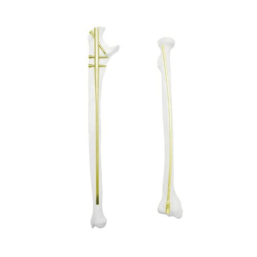 Marknagel für Radius - QML  - Kangli Medical - für Ulna / mit proximaler Fixierung / mit distaler Fixierung