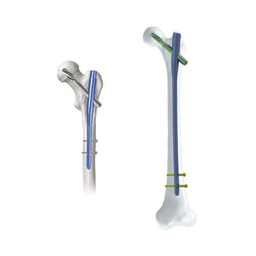Marknagel für Oberschenkelknochen - KTO PFNA - Kangli Medical - für Trochanter / mit proximaler Fixierung / Titan