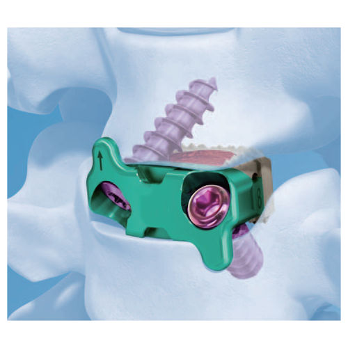 HWS-Zwischenwirbelimplantat - G-58020 - Kangli Medical - ventraler Zugang / aus PEEK