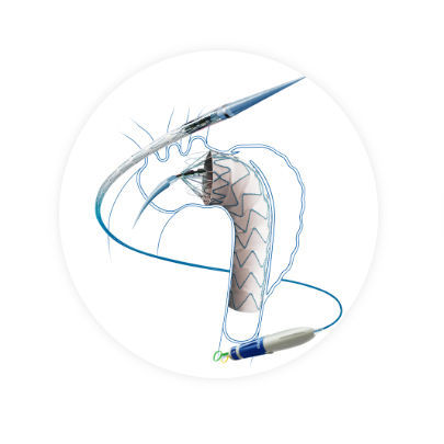 Stentgraft / aufsteigende Thoraxaorta - Hercules™ - Endovastec - Nitinol / Polyethylen