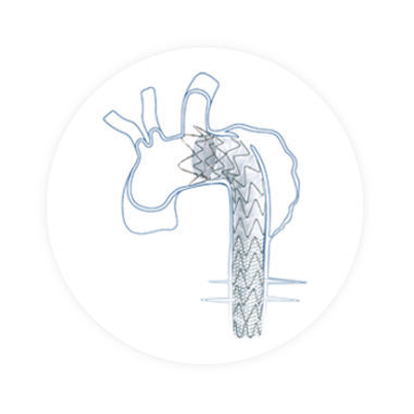 Stentgraft / aufsteigende Thoraxaorta - Talos™ - Endovastec - Nitinol