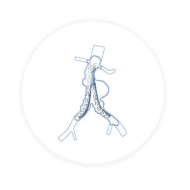 Stentgraft / Arteria iliaca - Hercules™ - Endovastec - Nitinol / Polyethylen