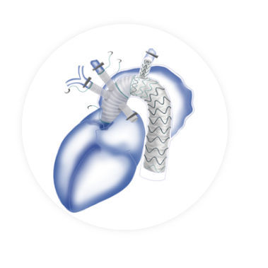 Aortenbogen-Stentgraft - Fontus™ - Endovastec - Nitinol / Polyethylen