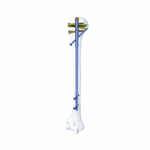Marknagel / Humerus - SHGK - Chongqing FWS Medical Device - mit proximaler Fixierung / mit diaphysärer Fixierung / Metall