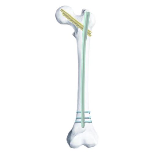 Marknagel für Oberschenkelknochen - SGG - Chongqing FWS Medical Device - Titan